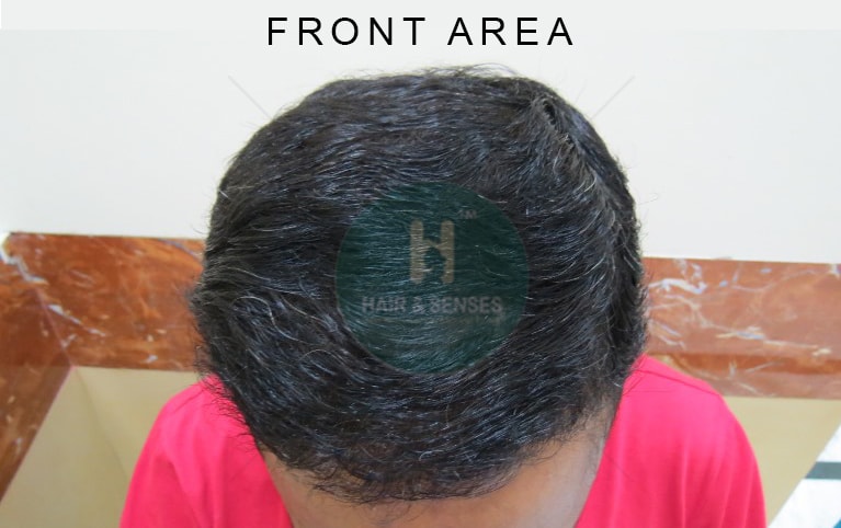 Hair Transplant